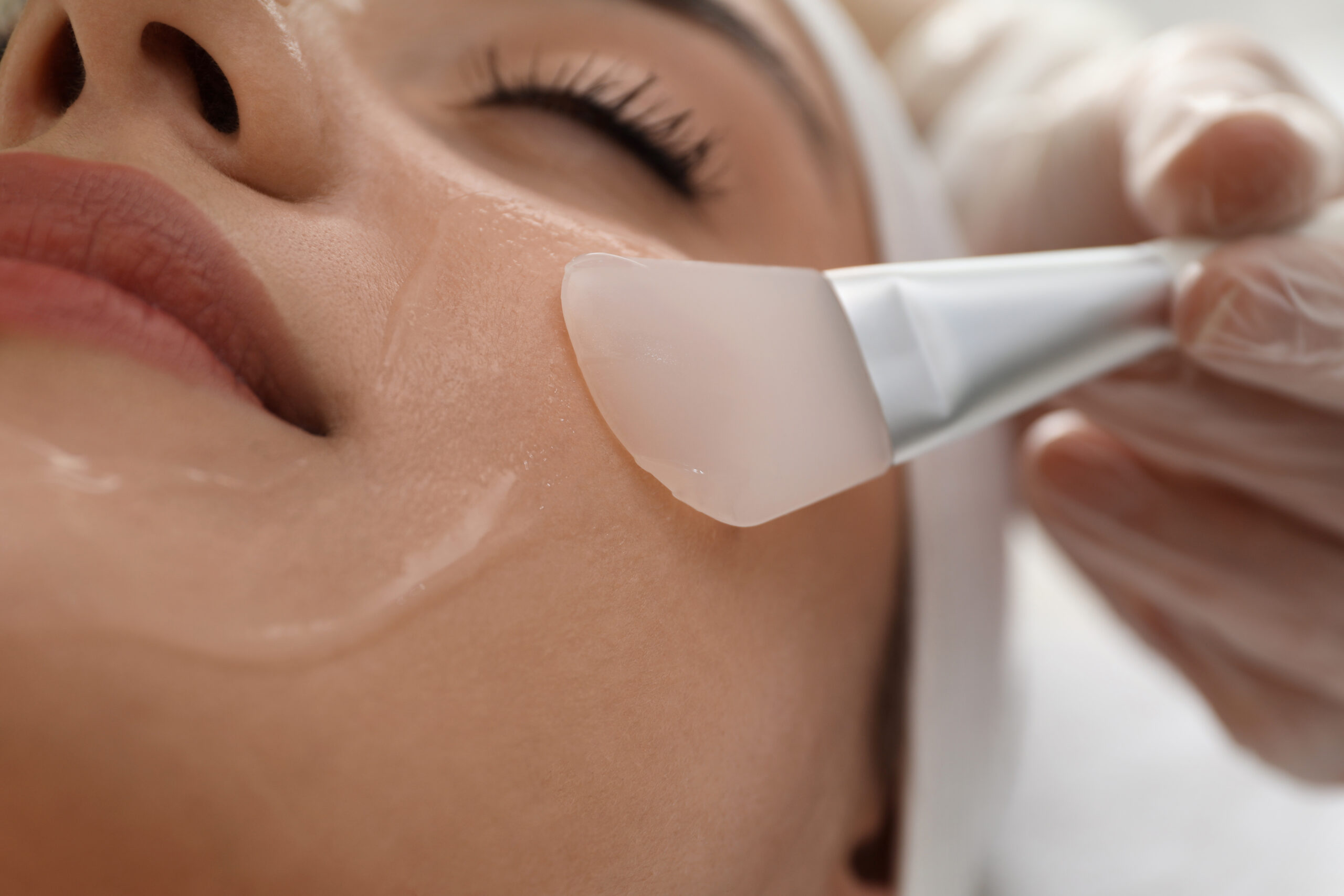 Young,Woman,During,Face,Peeling,Procedure,In,Salon,,Closeup